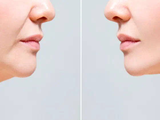 Mewing Explained: A Natural Way to Define Your Jawline