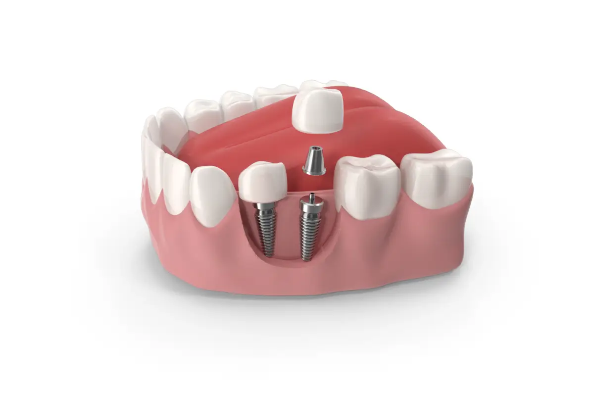 Dental Implant 3d image
